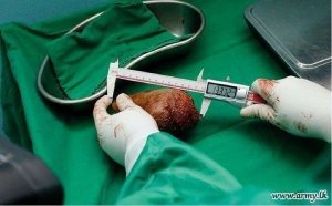 Médicos retiram de um homem a maior pedra no rim do mundo